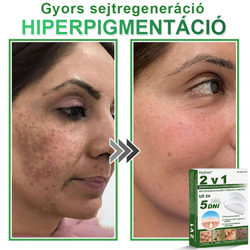 Hudros® hydrokoloidné náplasti s mikroihličkami (144 ks)
